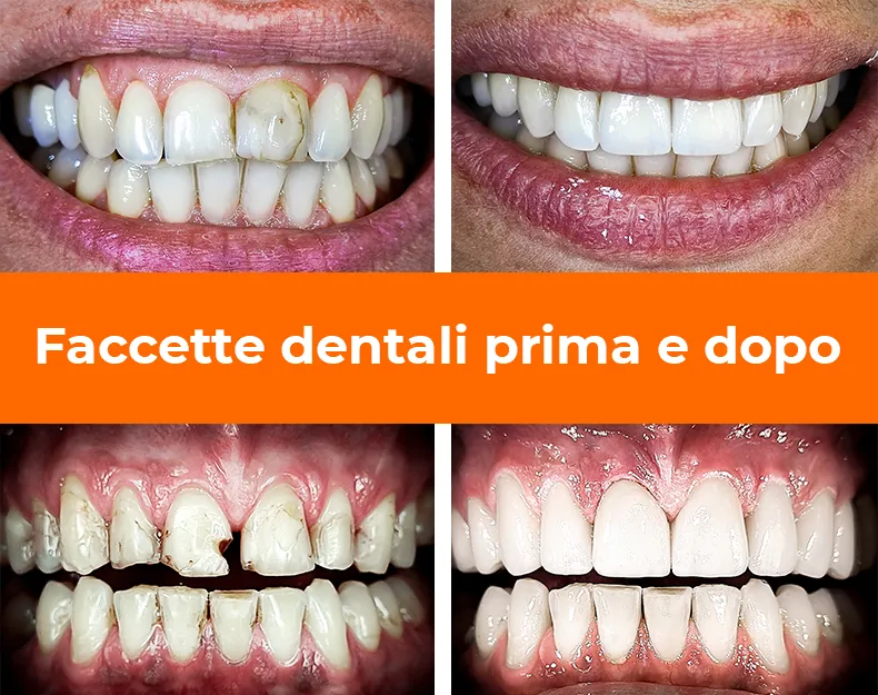 Faccette dentali prima e dopo - Dental Center