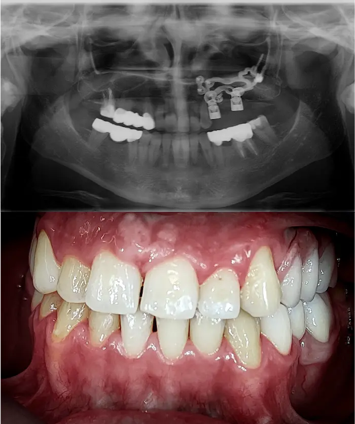 Subperiostalni unilateralni dopo - Dental Center