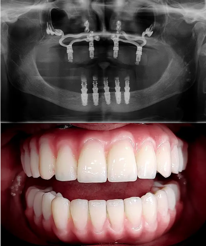 Subperiostalni arcata totale dopo - Dental Center