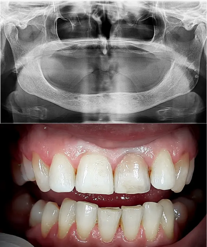 Subperiostalni arcata totale prima - Dental Center