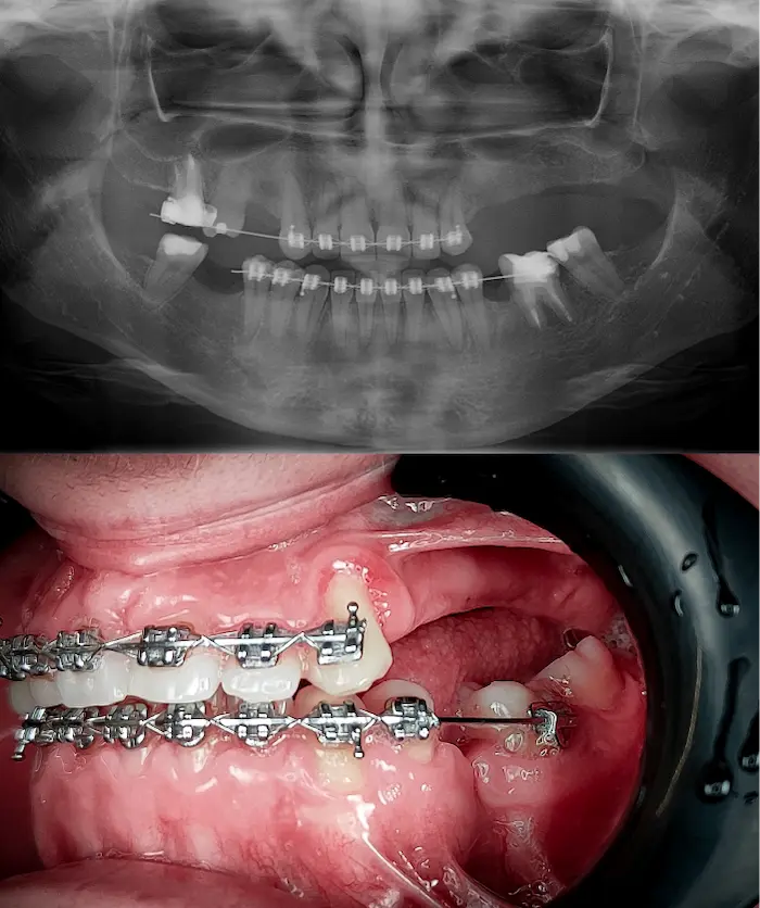 Subperiostalni unilateralni prima - Dental Center