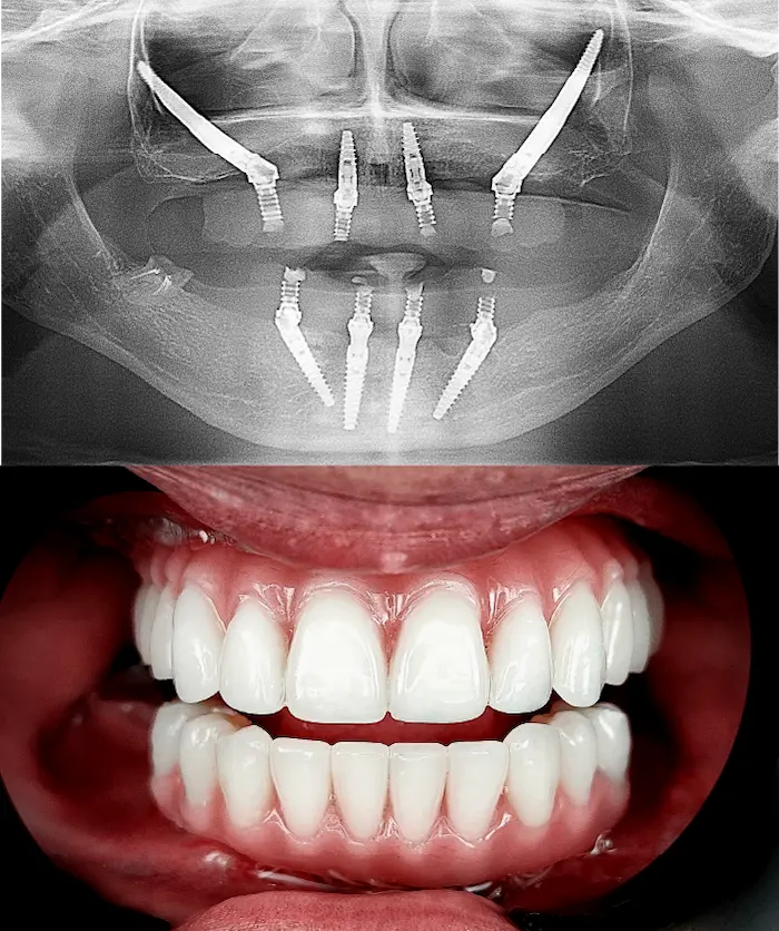 Zygoma hybrid dopo - Dental Center