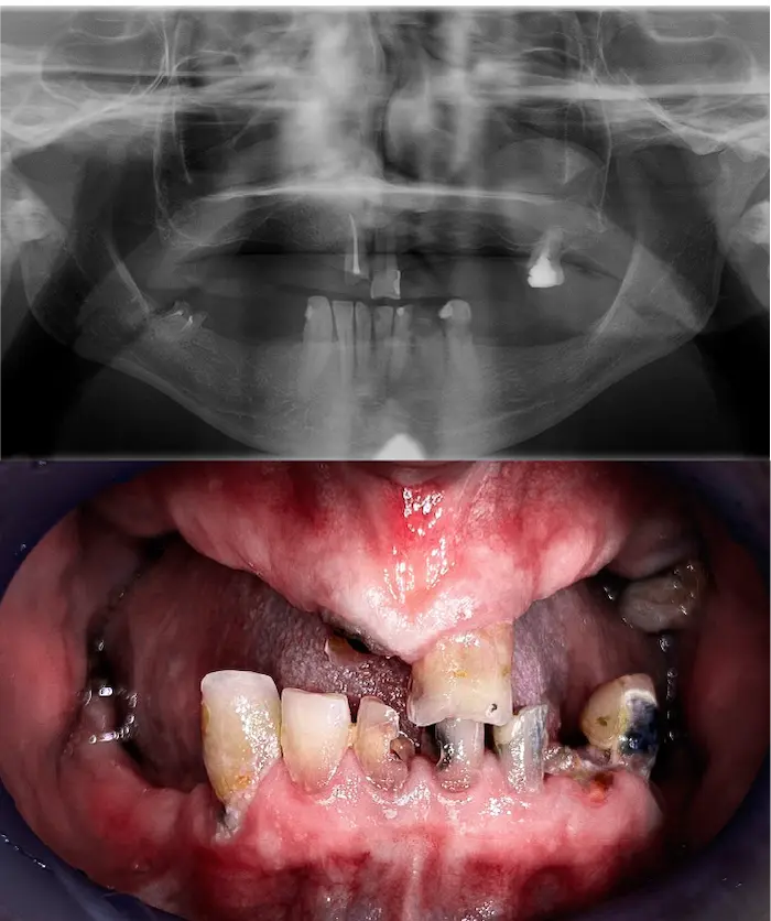 Zygoma hybrid prima - Dental Center