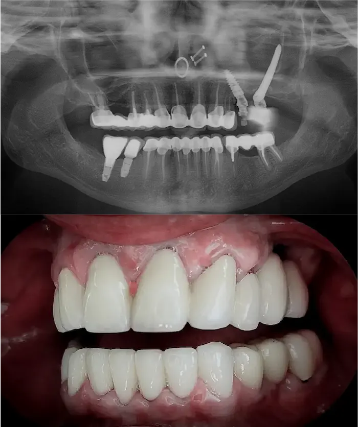 Zygoma laterale dopo - Dental Center
