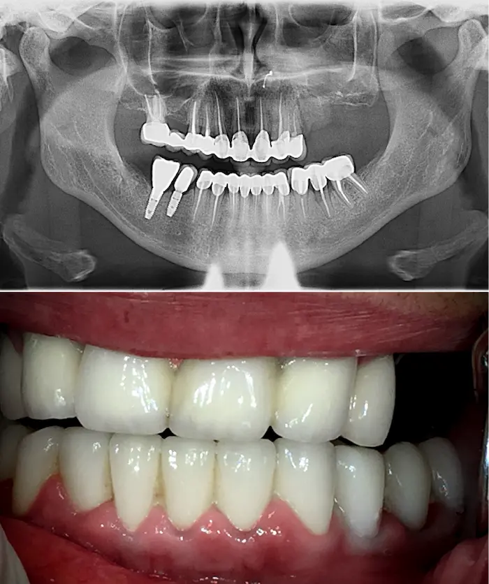 Zygoma laterale prima - Dental Center