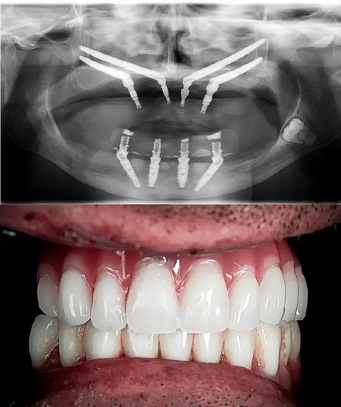 Zygoma quad dopo - Dental Center